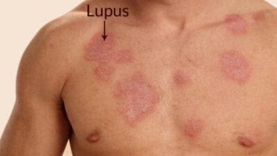 Eklem Ağrılarına Dikkat! Lupus Olabilirsiniz