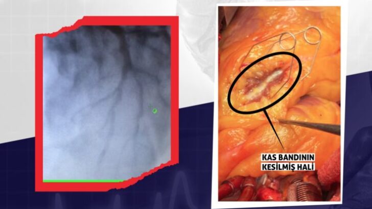 Doç. Dr. Mazlum Şahin’den Kalp Kası Bandı (Myokardial Bridge) Hastalığı ve Tedavisi Hakkında Bilgilendirme