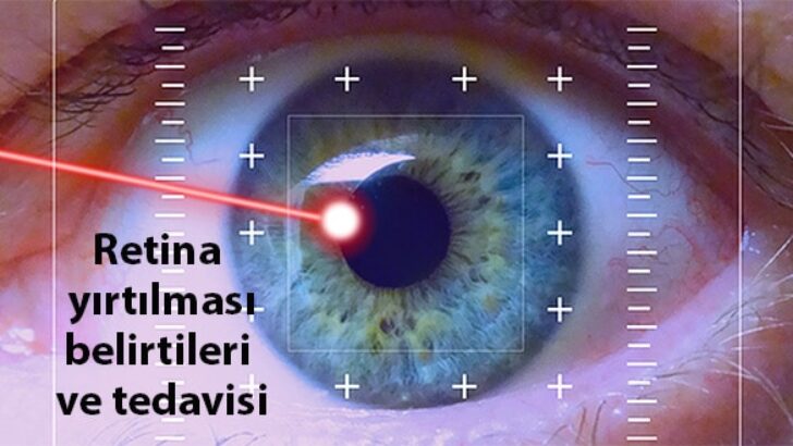 RETİNA YIRTIĞINDA ERKEN TEDAVİ UYARISI
