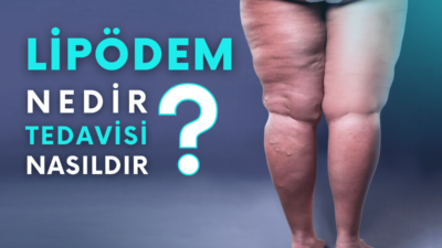 Kadınların Gizli Düşmanı: Lipödem!