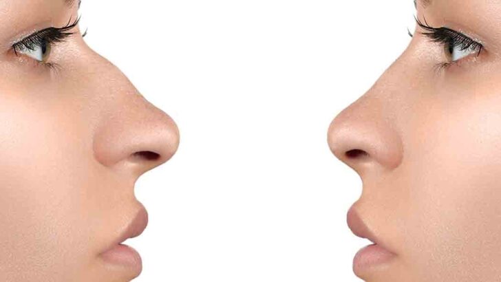 RİNOPLASTİ AMELİYATINA İLGİ ARTIYOR: ESTETİK VE SAĞLIKTA ÇİFT ETKİ